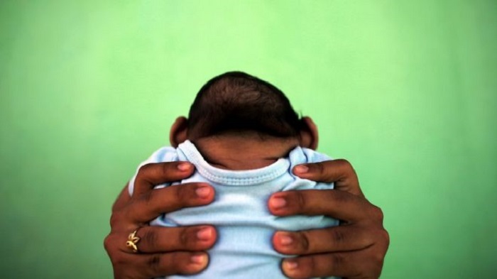 First Guatemalan baby born with Zika-linked microcephaly